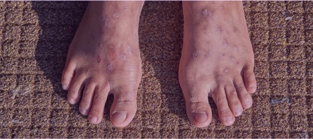 Stasis dermatitis